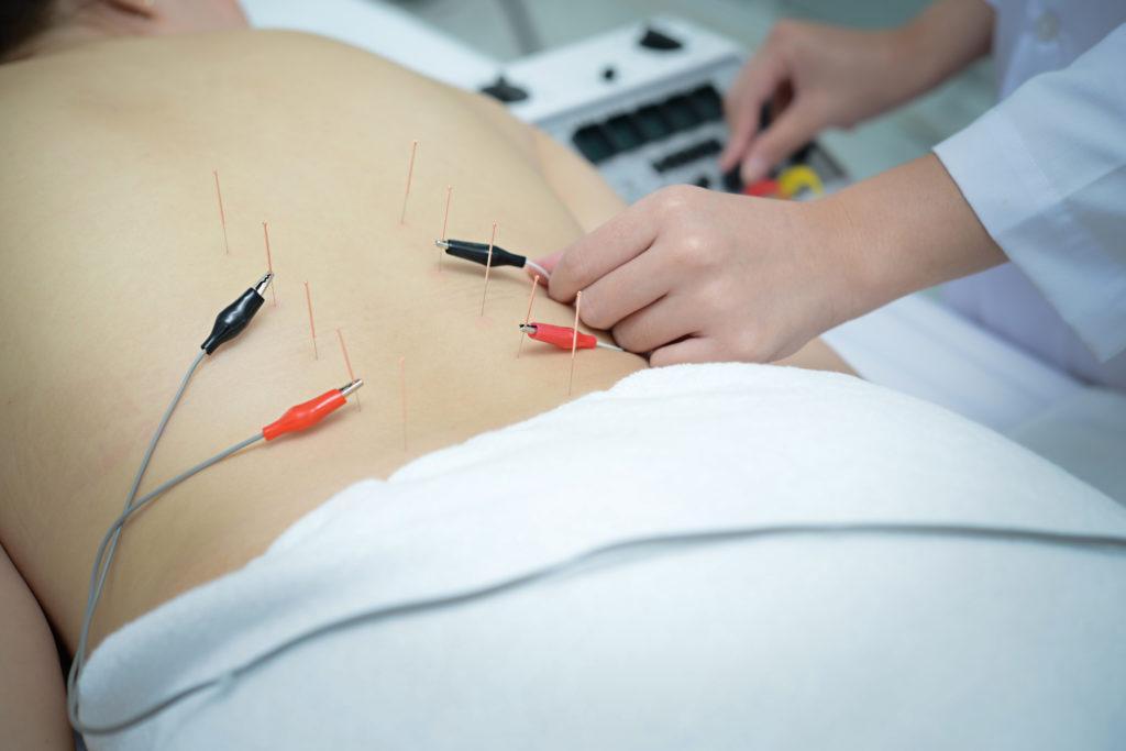 Electro Acupuncture.Traditional Chinese acupuncture and Electroacupuncture on body of patient